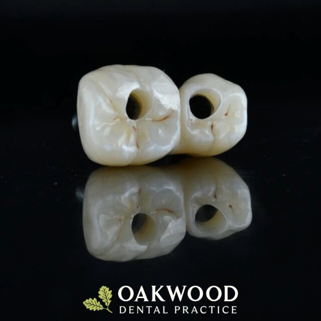 A dental implant is a permanent solution for replacing a missing tooth. A small titanium post is placed into the jawbone to act as a replacement root, before a custom-made crown is fitted on top for a natural-looking, fully functional smile.

With advanced digital planning, implant treatment is precise, predictable, and tailored to you.

Interested in restoring your smile? Book a consultation with our team today.

#DentalImplants #SmileRestoration #MissingTeeth #ImplantDentistry #DigitalDentistry #HealthySmile #oakwooddentalpractice @vivodentallab