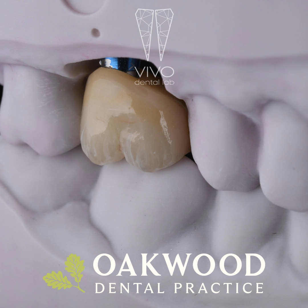 Replacing missing teeth with confidence 🦷✨

Dental implants provide a strong, natural-looking solution to restore your smile. At Oakwood Dental Practice, we offer in-house implant placement, allowing your entire implant journey to be carefully planned and carried out by our experienced team in one familiar setting.

From digital planning through to placement and restoration, we’re with you every step of the way.

@vivodentallab 

#DentalImplants #ImplantDentistry #SmileRestoration #DigitalDentistry #MissingTeeth #ConfidentSmile #OakwoodDentalPractice