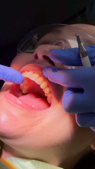 ✨ A smile transformation that speaks for itself! 😁

We’re so happy to see our patient’s confidence shine through after completing their Invisalign® treatment. From the first aligner to the final result, it’s been amazing to be part of their smile journey. 🦷✨

Clear aligners. Subtle changes. A smile they’re proud to show off. 💫

Thank you for trusting us with your smile! 🤍

#Invisalign #InvisalignSmile #SmileTransformation #ClearAligners #PatientJourney PatientSatisfaction ConfidentSmile SmileMakeover Orthodontics BeforeAndAfter HappyPatient
