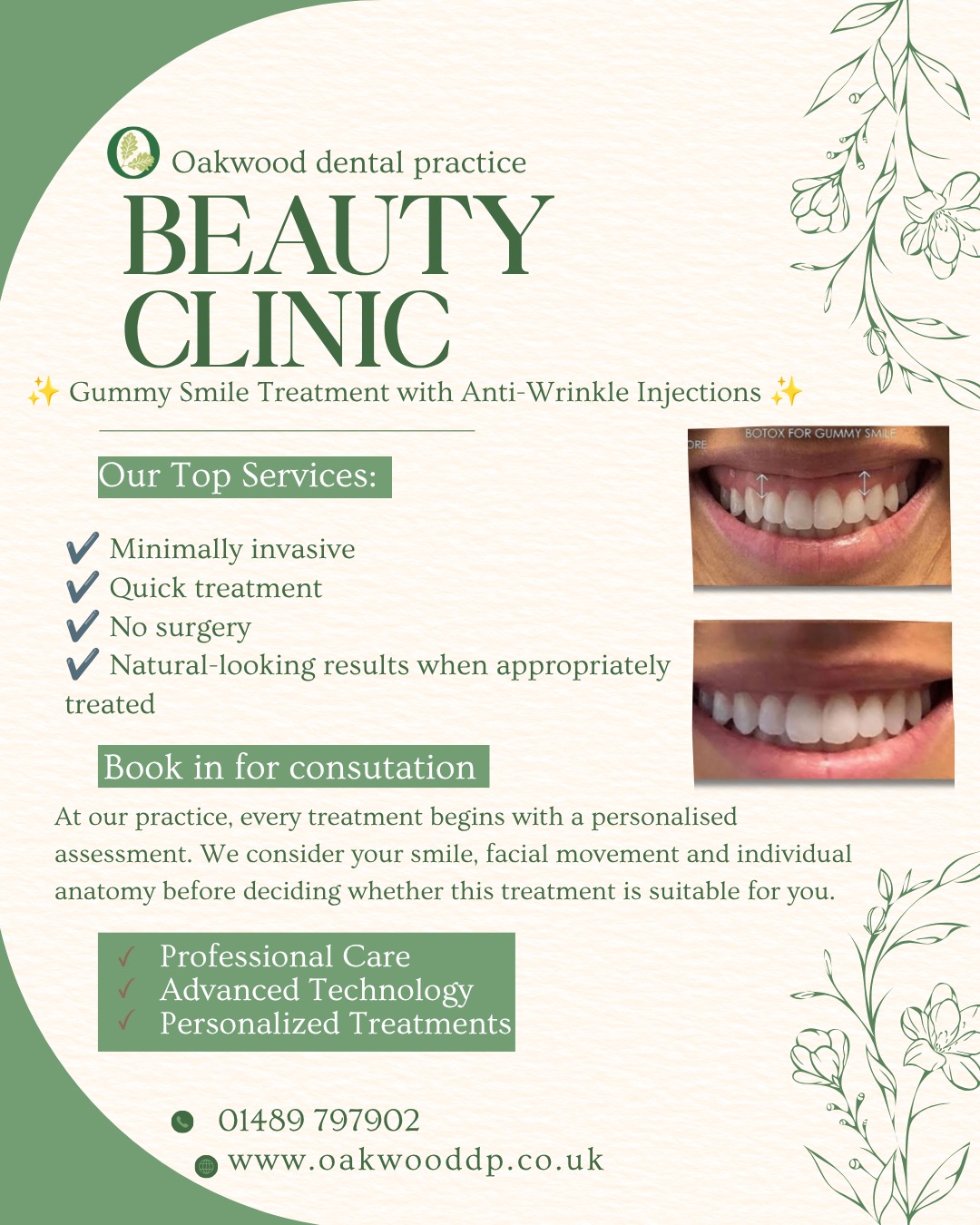 ✨ A subtle change for a beautifully balanced smile.
Our patient was treated for a **gummy smile with Botox® (lip flip)**, helping to soften the movement of the upper lip and reduce the appearance of excess gum when smiling.
Every smile is unique, which is why a **consultation is required first** to assess your individual needs and suitability for treatment.
📞 Call us or get in touch to book your consultation. 🤍