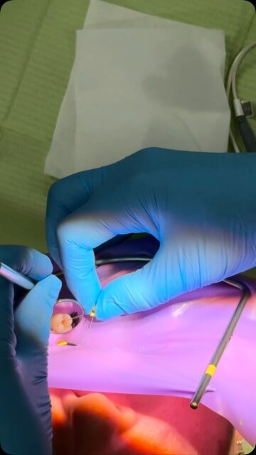 🦷 Save your tooth, relieve the pain! Root canal treatment removes infection, preserves your natural tooth, and restores your healthy smile. ✨😁 #oakwooddentalpractice #dentalcare #patientcare